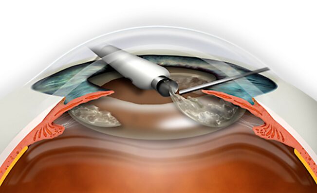 Replacement of refractive lenses is carried out through Micronadle, which does not include blood loss