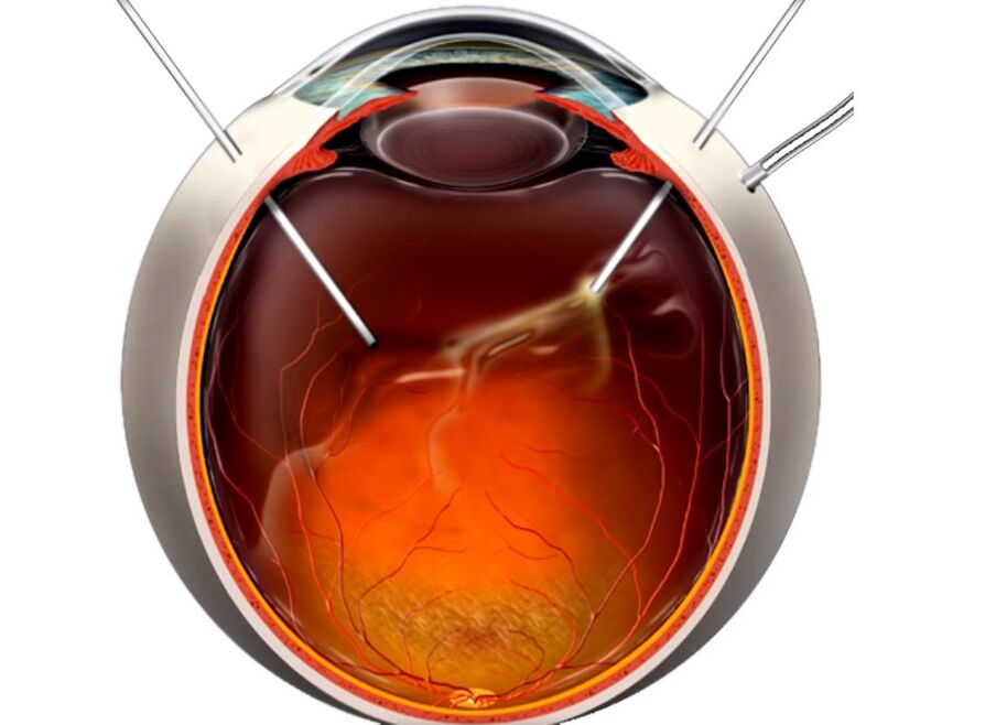 Vitrectomy - a procedure shown to people when retinal exfoliation